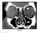 Fig. 05 - Automatic ENT surgery preplanning using a backtracking maze problem solution