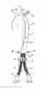 Fig. 01 - APPARATUS AND METHODS FOR ENDOLUMINAL GRAFT PLACEMENT