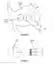 Fig. 07 - Methods and apparatus for treating glottic insufficiency
