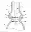 Fig. 01 - Prosthetic valve system having a docking component and a prosthetic valve component
