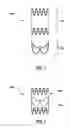 Fig. 02 - Prosthetic valve system having a docking component and a prosthetic valve component