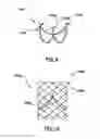 Fig. 05 - Prosthetic valve system having a docking component and a prosthetic valve component