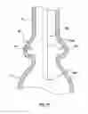 Fig. 07 - Prosthetic valve system having a docking component and a prosthetic valve component