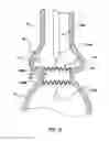 Fig. 08 - Prosthetic valve system having a docking component and a prosthetic valve component