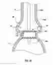 Fig. 09 - Prosthetic valve system having a docking component and a prosthetic valve component