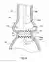 Fig. 10 - Prosthetic valve system having a docking component and a prosthetic valve component