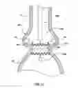 Fig. 12 - Prosthetic valve system having a docking component and a prosthetic valve component