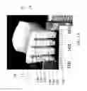 Fig. 02 - Customized bendable osteochondral allografts