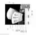 Fig. 03 - Customized bendable osteochondral allografts