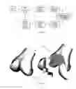 Fig. 22 - Customized bendable osteochondral allografts