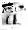 Fig. 02 - Modification of the surface topography of cartilage grafts for joint reconstruction