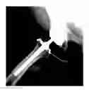 Fig. 01 - Hip replacement systems and methods