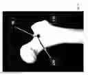 Fig. 09 - Hip replacement systems and methods