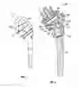 Fig. 02 - Directional locking reverse shoulder prostheses and systems