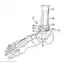 Fig. 01 - Modular talar fixation method and system