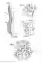 Fig. 02 - Crossbar spinal prosthesis having a modular design and systems for treating spinal pathologies