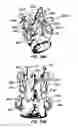 Fig. 28 - Crossbar spinal prosthesis having a modular design and systems for treating spinal pathologies