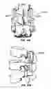 Fig. 32 - Crossbar spinal prosthesis having a modular design and systems for treating spinal pathologies