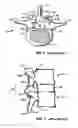 Fig. 03 - Implantable orthopedic device component selection instrument and methods