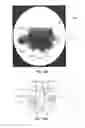 Fig. 18 - Implantable orthopedic device component selection instrument and methods