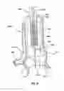 Fig. 07 - STENT ASSEMBLIES INCLUDING PASSAGES TO PROVIDE BLOOD FLOW TO CORONARY ARTERIES AND METHODS OF DELIVERING AND DEPLOYING SUCH STENT ASSEMBLIES
