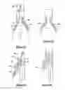 Fig. 04 - Vascular endograft