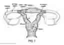 Fig. 02 - SYSTEM AND METHOD FOR FALLOPIAN TUBE OCCLUSION