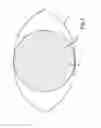 Fig. 03 - Treatment apparatus for correcting a refractive error of an eye