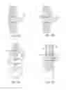 Fig. 04 - Bioabsorbable tissue support adjunctive to tissue piercing