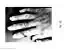 Fig. 77 - MEDICAMENT FOR TREATING PERIPHERAL NEUROPATHIES