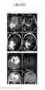 Fig. 26 - Methods and compositions for treating cancers and enhancing therapeutic immunity by selectively reducing immunomodulatory M2 monocytes