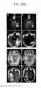 Fig. 27 - Methods and compositions for treating cancers and enhancing therapeutic immunity by selectively reducing immunomodulatory M2 monocytes