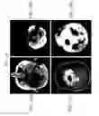 Fig. 38 - Methods and compositions for treating cancers and enhancing therapeutic immunity by selectively reducing immunomodulatory M2 monocytes