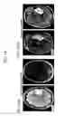 Fig. 61 - Methods and compositions for treating cancers and enhancing therapeutic immunity by selectively reducing immunomodulatory M2 monocytes