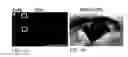 Fig. 17 - TREATMENT OF RESISTANT LESIONS