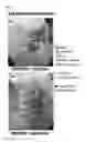 Fig. 34 - Lyophilized polymer scaffold compositions, processes for preparation and use in anabolic wound repair