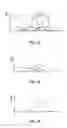 Fig. 17 - Adjunct material to provide controlled drug release