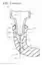 Fig. 08 - Elastic cap and syringe assembly therewith