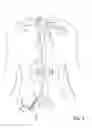 Fig. 04 - Devices for transvascular retrograde access placement