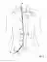 Fig. 05 - Devices for transvascular retrograde access placement