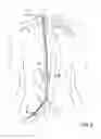 Fig. 06 - Devices for transvascular retrograde access placement
