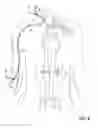 Fig. 09 - Devices for transvascular retrograde access placement