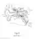 Fig. 04 - Dilation catheter with expandable stop element