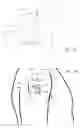 Fig. 17 - Systems and methods for treating shoulder pain related to subacromial impingement syndrome