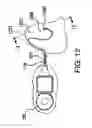 Fig. 19 - Implantable stimulating assembly