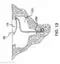 Fig. 20 - Implantable stimulating assembly