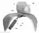 Fig. 01 - Multi-electrode epicardial pacing