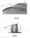 Fig. 09 - Multi-electrode epicardial pacing