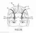 Fig. 04 - Extracranial implantable devices, systems and methods for the treatment of neuropsychiatric disorders