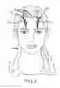 Fig. 05 - Extracranial implantable devices, systems and methods for the treatment of neuropsychiatric disorders